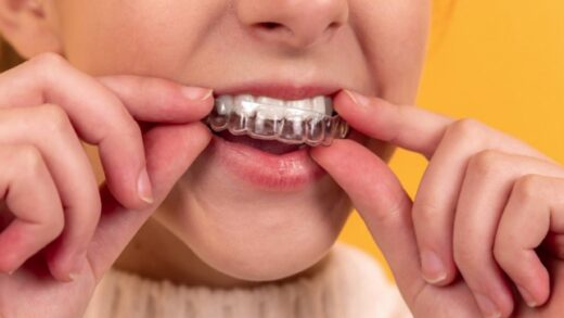 7 вещей, которые вы должны знать, прежде чем начать лечение с помощью Invisalign