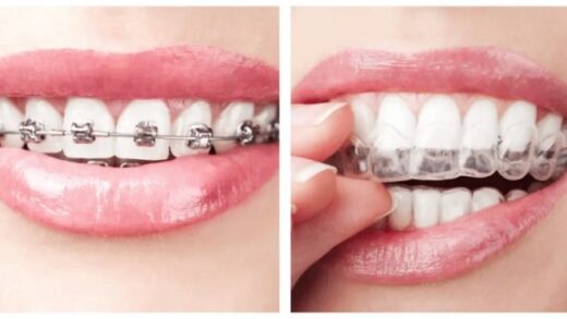 Invisalign против традиционных брекетов: плюсы, минусы и что лучше?