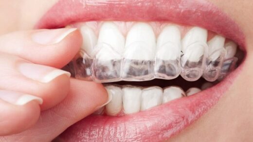 Лечение с помощью системы Invisalign: пошаговый процесс