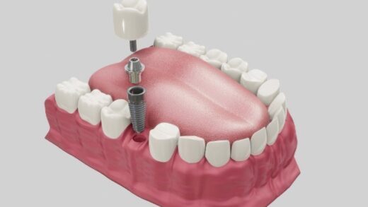 Однодневная имплантация зубов: подходит ли она вам