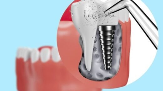 Распространенные проблемы с зубными имплантатами и советы по их профилактике