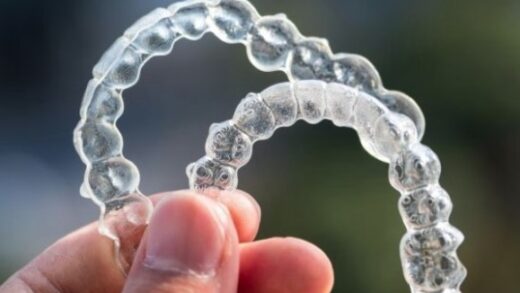 Сроки лечения с помощью системы Invisalign: сколько времени занимает выравнивание зубов?