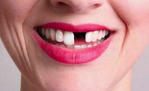 8 причин никогда не игнорировать отсутствие зуба: риски и уход