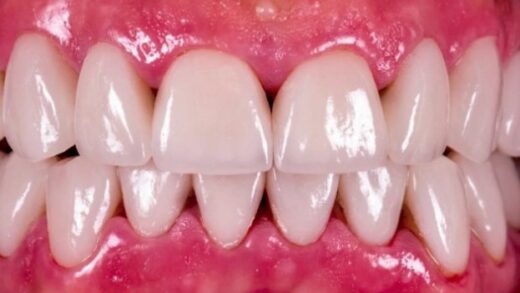 Что такое «черный треугольник» в стоматологии? Причины и лечение