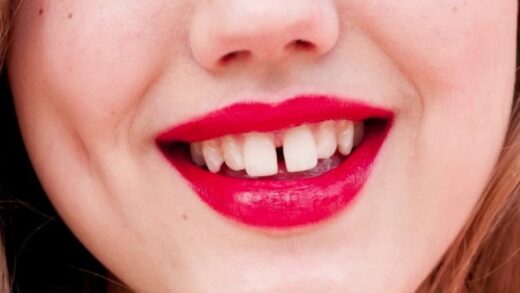 Как исправить щель между зубами: причины и варианты лечения