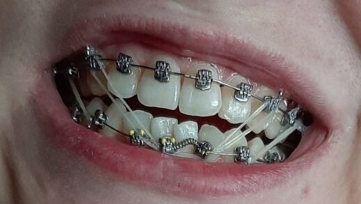 Путешествие с брекетами: как поддерживать чистоту в любом месте